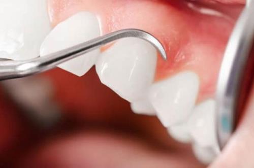 روش زیبایی و ترمیم دندان