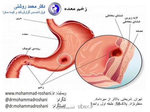 آندوسكوپی معده